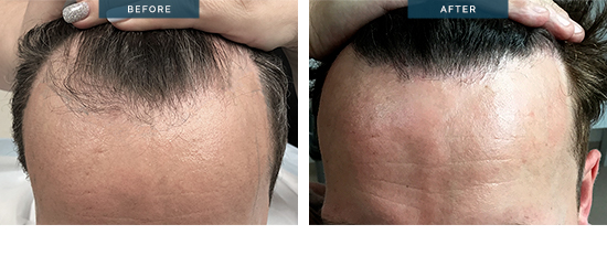 FUE hair transplant before and after 11, 1400 grafts, top results