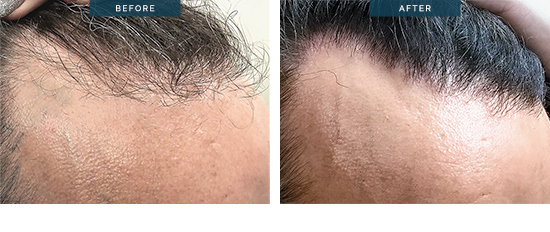 Hair transplant before and after 03, 14oo Grafts FUE after 8 months, Dr Spano Melbourne