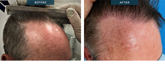 Male hair transplant before and after of 1600 Grafts FUE 46 y.o. male, right side view 01