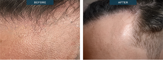 FUE hair transplant, 1400 grafts, before and after 13, Dr Spano Melbourne