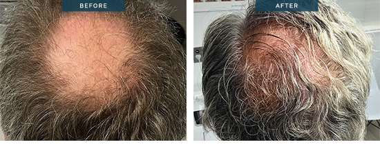 Hair transplant results 10, male 2400 FUT, 8 months later