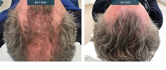 FUT hair transplant before and after 02, 2400 Grafts, 9 months after surgery, HTM Melbourne, Dr Spano