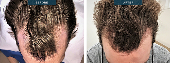 09 hair transplant male 1600 FUE. This is the result at 8 months only.