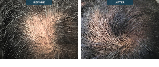 FUE hair transplant before and after 08, crown, 700 Grafts, 8 months, male patient