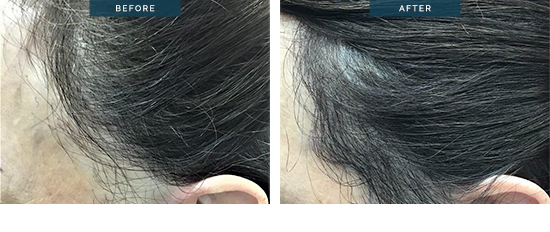 Hair transplant before and after 12, female patient, 1800 FUT