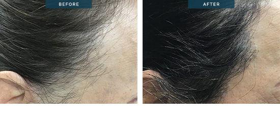 Melissa, hair transplant before and after 13, female 1800 FUT (8 months post)