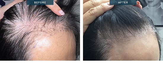 Female hair transplant, FUT 2232 grafts, before and after 14