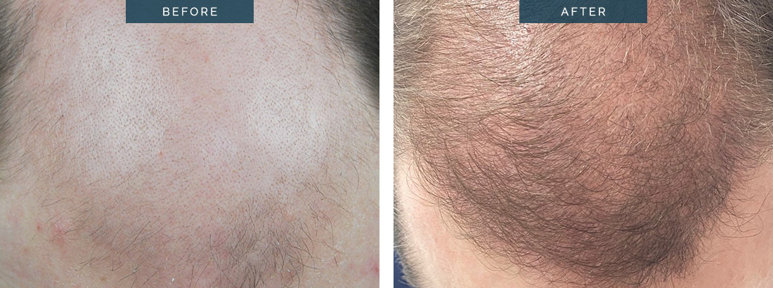 New Hair Transplant Growth 19, HTM Melbourne, Dr Spano, FUT 3182 grafts