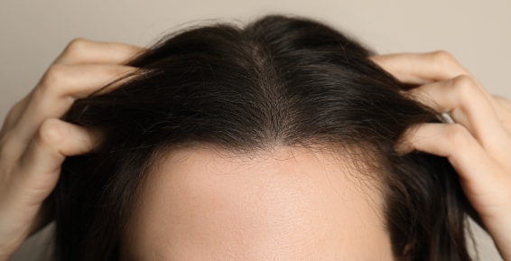 Female hair transplants, before and after 020, HTM Clinic Melbourne