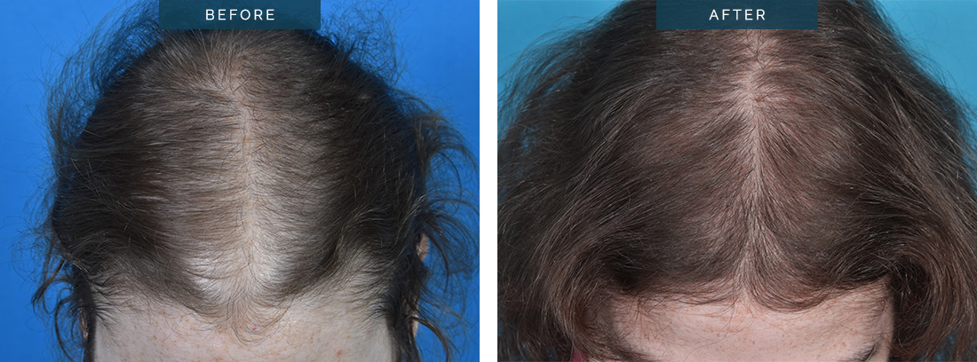 Female hair transplant in Melbourne, before and after 10, FUT strip 1958 grafts.