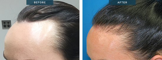 Female hair transplant before and after 15