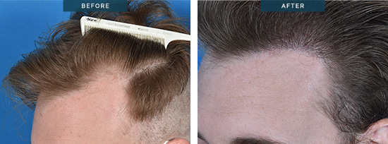 Matt, hair transplant before and after 01, FUE 2407 grafts @ 8 months