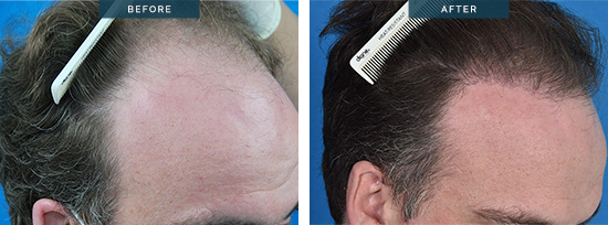 Greg, hair transplant before and after 01, FUT 3400 grafts (6800 hairs) in one day