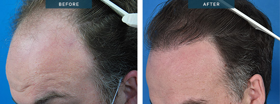 FUT hair transplants in Melbourne, Greg 01-2, FUT 3400 grafts (6800 hairs) in one day to re-create a decent hairline. Left side view.