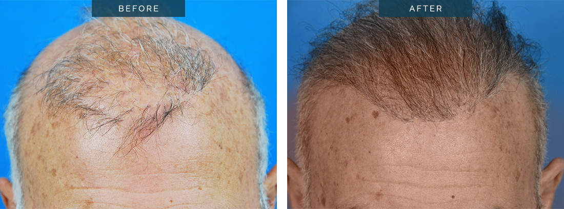 Beard to scalp hair transplant, before and afters, after multiple sessions, Dr Spano Melbourne