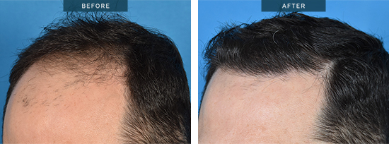 Mike 01, hair transplant i Melbourne, 12 months post his FUE procedure. FUE 2606 grafts.
