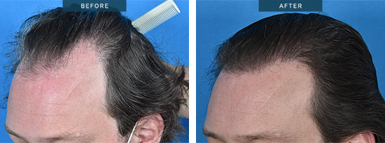 Hair transplant results in Melbourne, Matt 01-3, FUT 2375 grafts – No Shaving, left side view