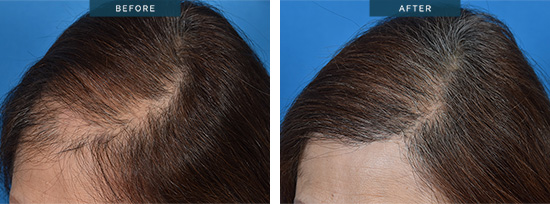 Female hair transplant in Melbourne 05, Violet, FUT 2403 grafts – NO SHAVING