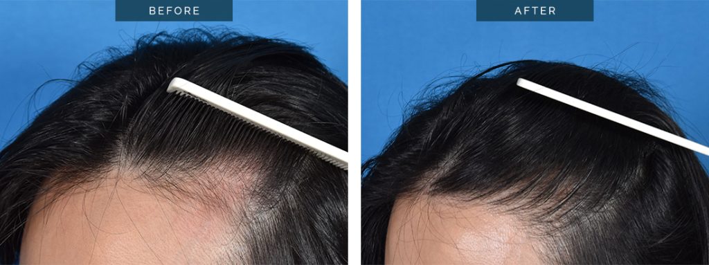 Female Hair Transplant | Hairline Lowering | Eyebrows 2023