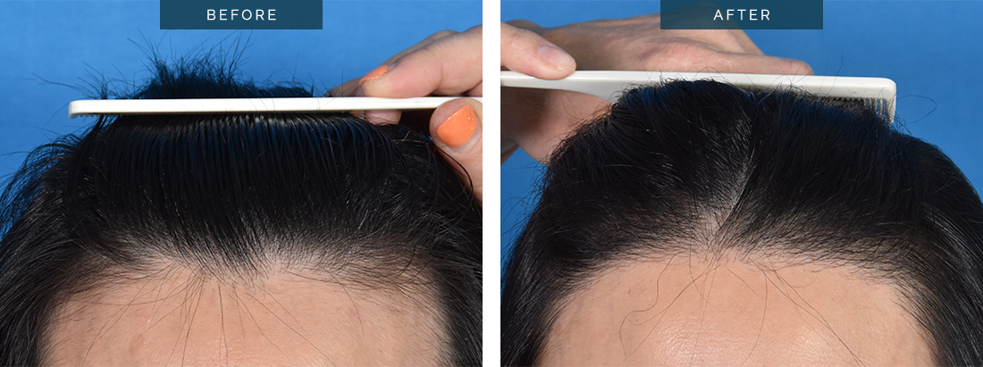 Female hair transplant results 02, FUT 2304 grafts – NO SHAVING, 14 months, Dr Paul Spano and Dr Christine Parkinson