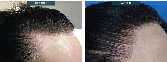 Michelle hairline lowering treatment before and after (7-months post), NO SHAVING FUT 2645 grafts