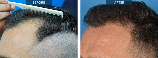 Hair transplants before and after 02-2, Andrew, FUE 2502 grafts, pre and 13 month after procedure, left side view