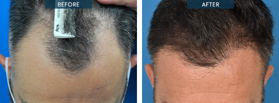 HTM patient Andrew, before and after FUE hair transplant 02-3 (2502 grafs, 13 months post)