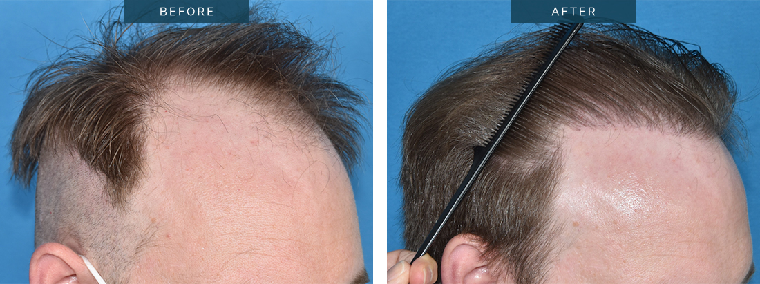 Low-Cost Hair Transplants – means low quality? -