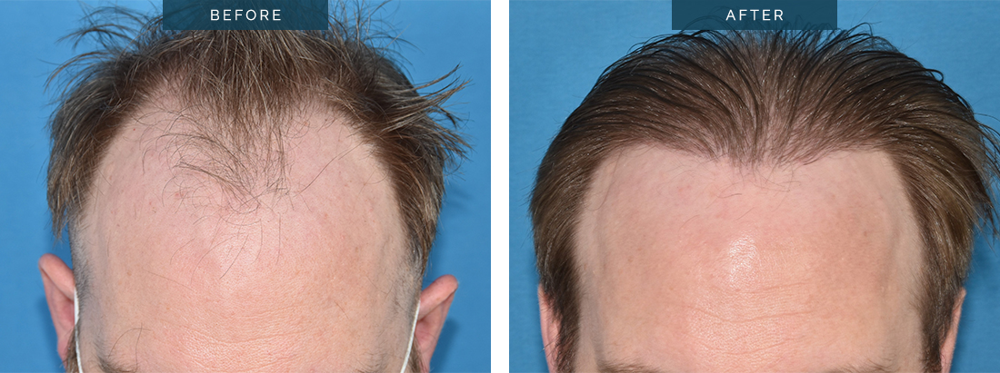 Front Hairline Transplant -
