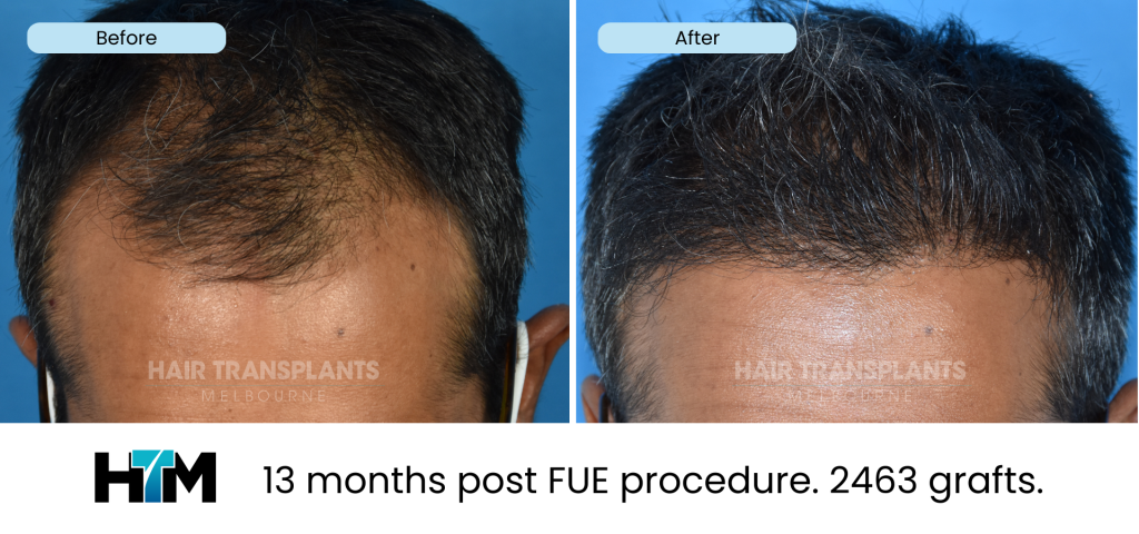 10.1 - 13 months post FUE procedure. 2463 grafts