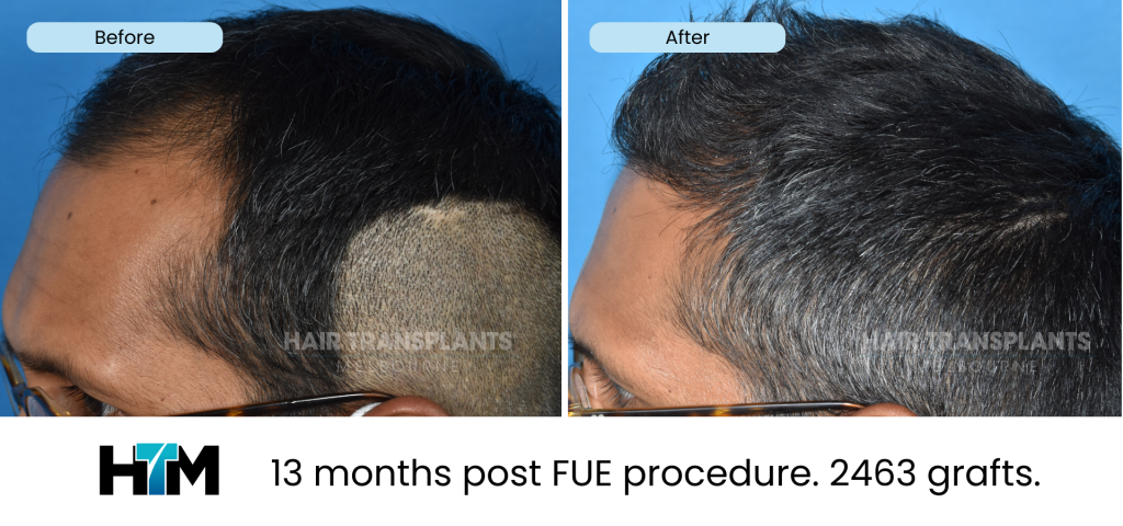 10.2 - 13 months post FUE procedure. 2463 grafts
