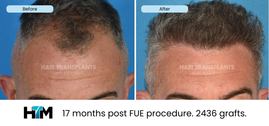11.1 - 17 months post FUE procedure. 2436 grafts