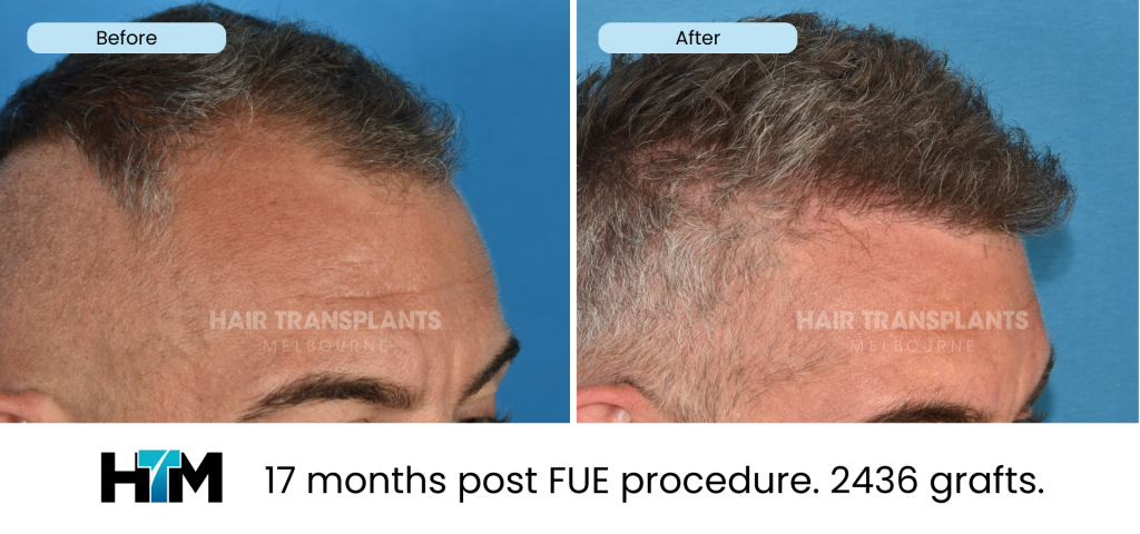 11.2 - 17 months post FUE procedure. 2436 grafts