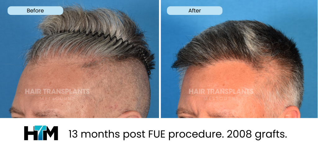 12.1 - 13 months post FUE procedure. 2008 grafts