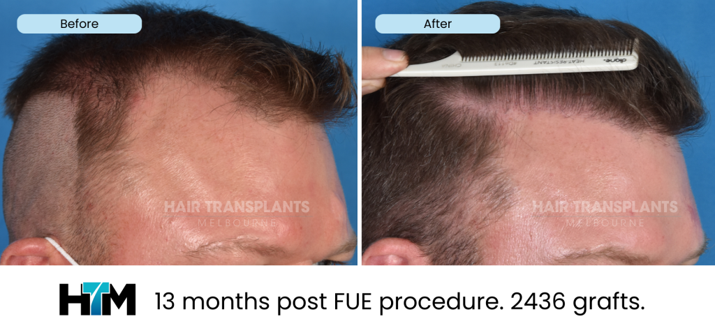 13.1 - 13 months post FUE procedure. 2436 grafts