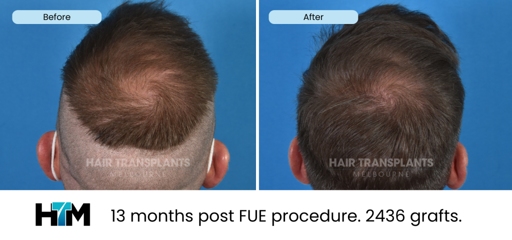 13.2 - 13 months post FUE procedure. 2436 grafts