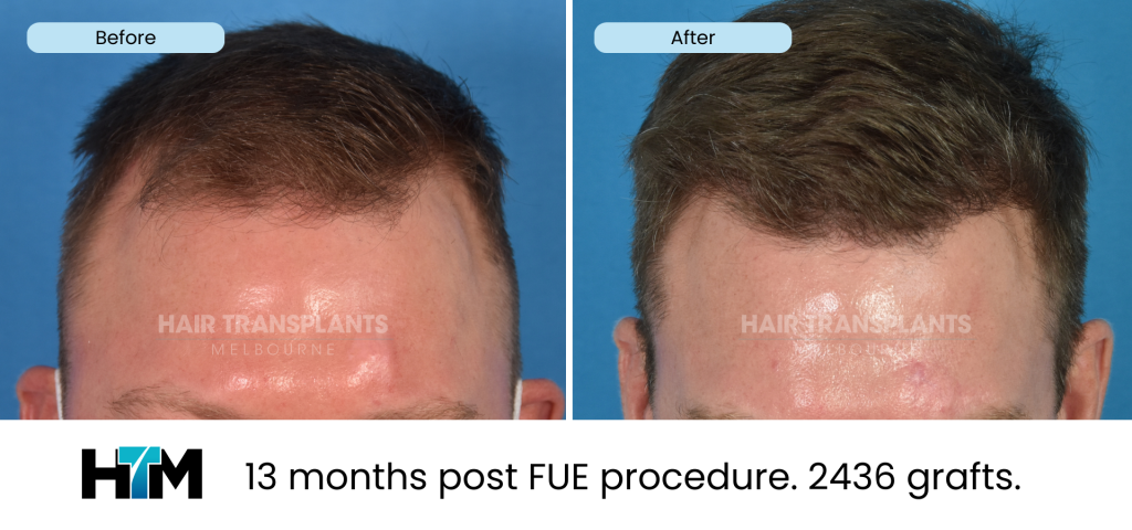 13.3 - 13 months post FUE procedure. 2436 grafts