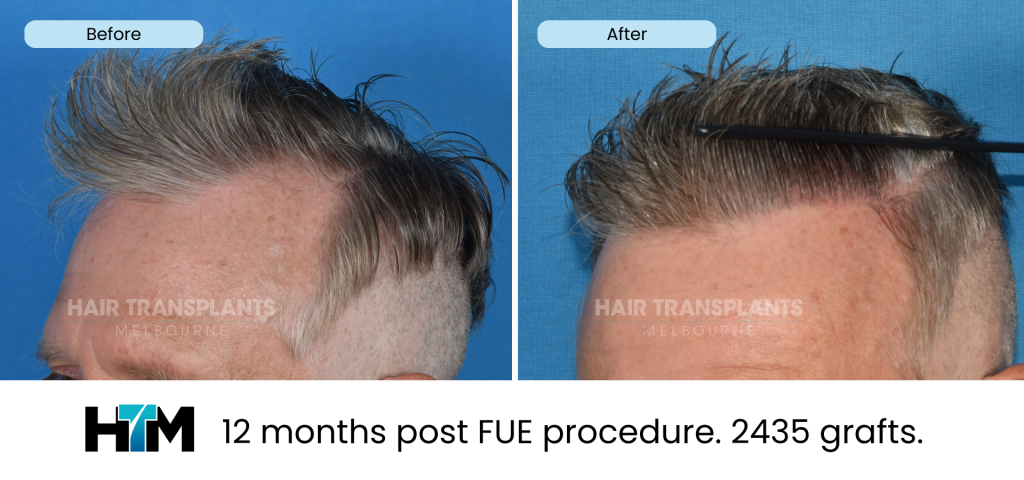 14.1 - 12 months post FUE procedure. 2435 grafts