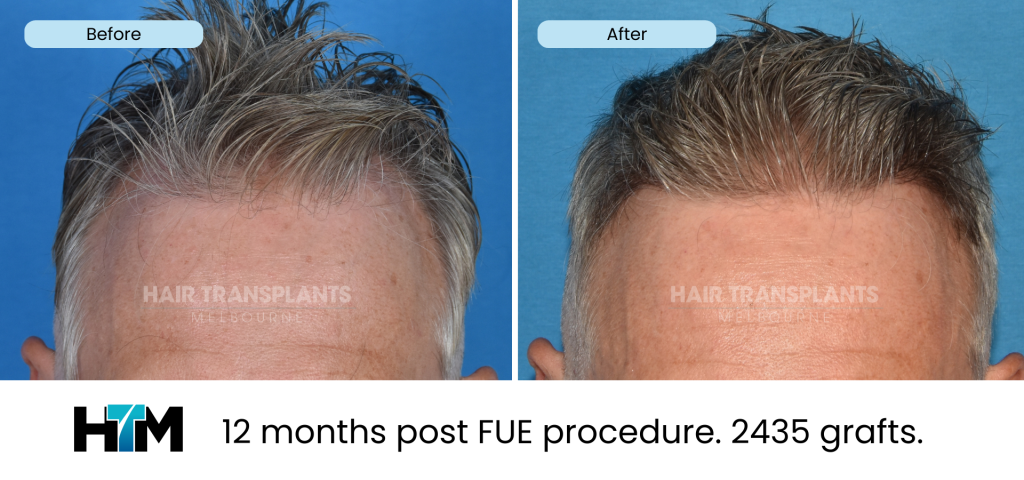 14.2 - 12 months post FUE procedure. 2435 grafts