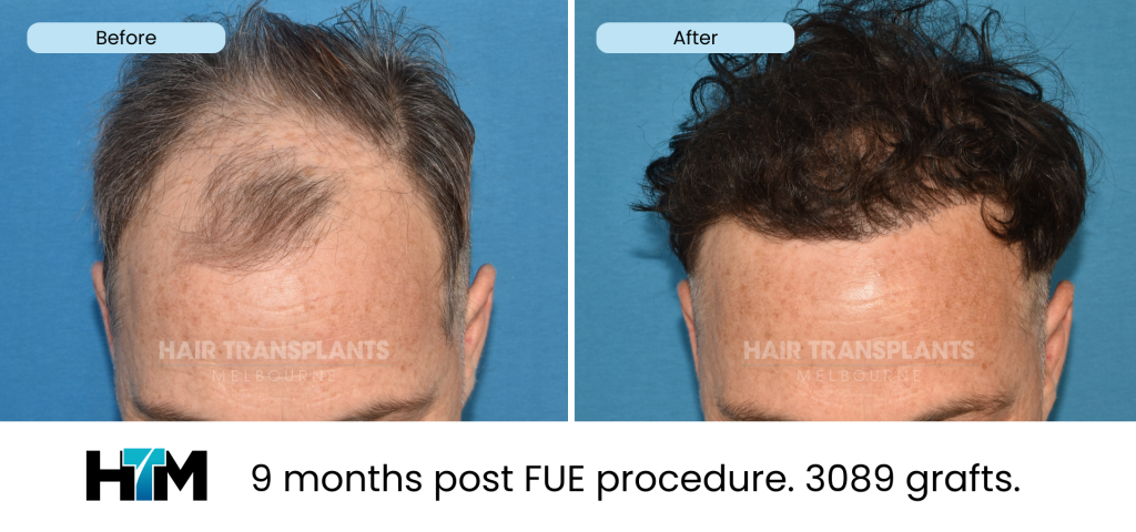 15.1 - 9 months post FUE procedure. 3089 grafts