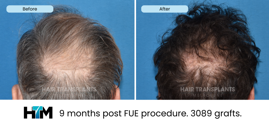 15.2 - 9 months post FUE procedure. 3089 grafts