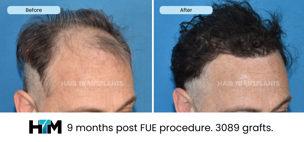15.3 - 9 months post FUE procedure. 3089 grafts