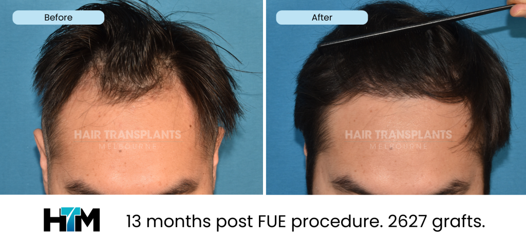 16.1 - 13 months post FUE procedure. 2627 grafts