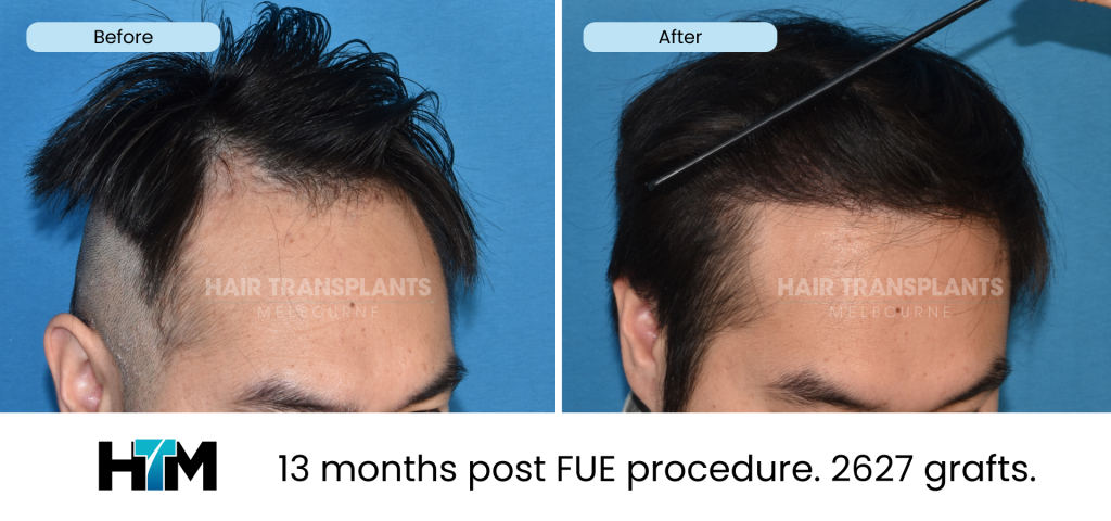 16.2 - 13 months post FUE procedure. 2627 grafts