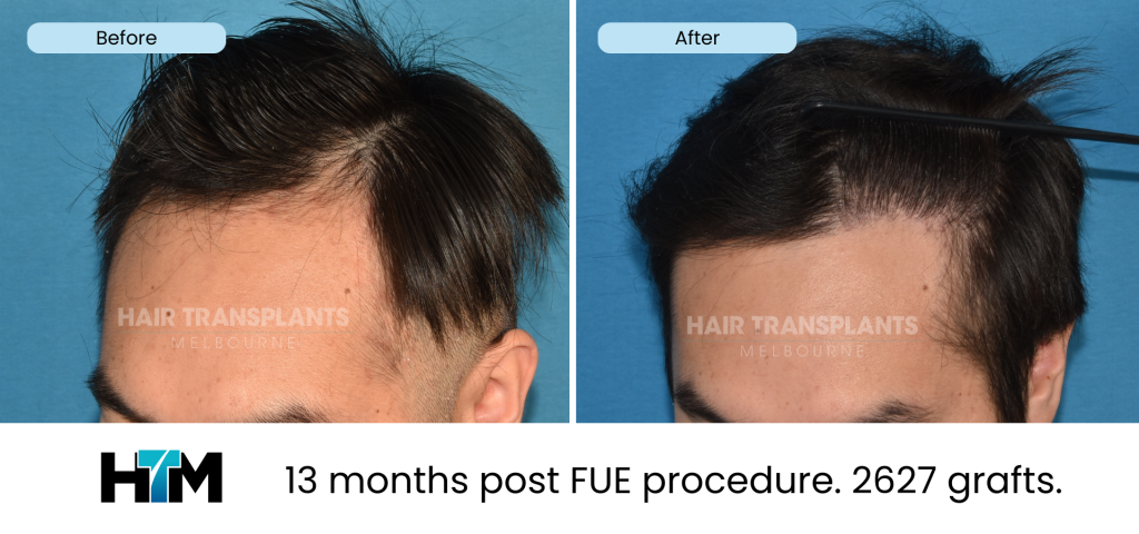 16.3 - 13 months post FUE procedure. 2627 grafts
