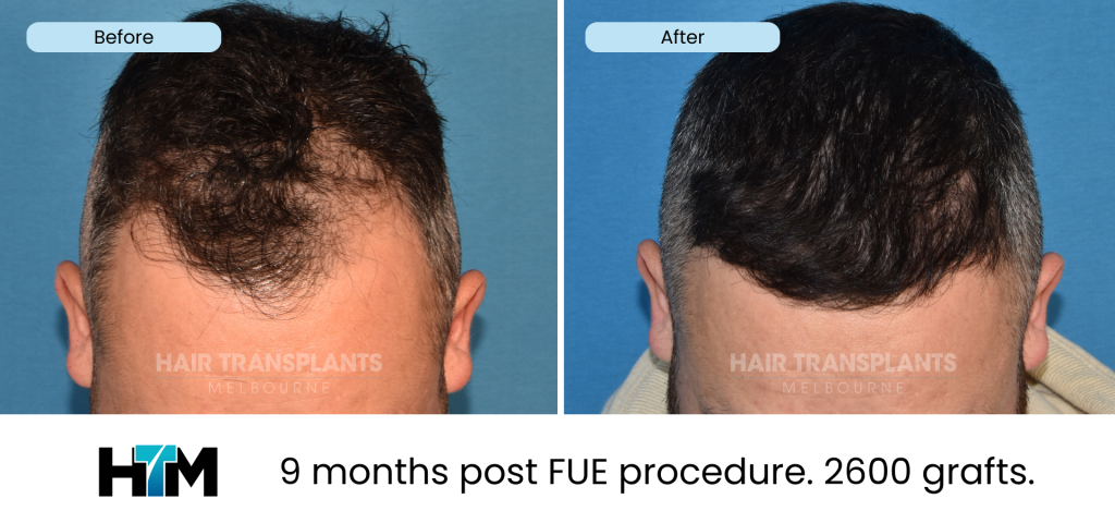 17.1 - 9 months post FUE procedure. 2600 grafts