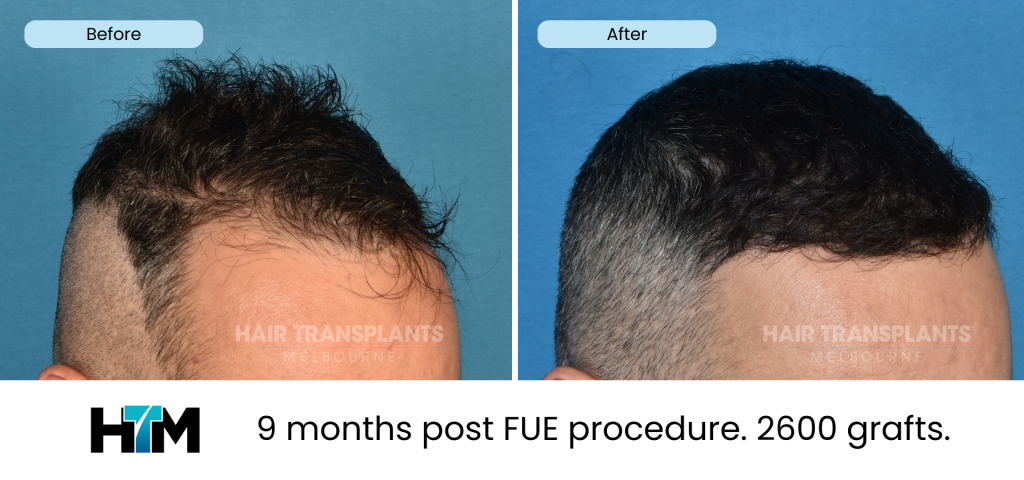 17.2 - 9 months post FUE procedure. 2600 grafts