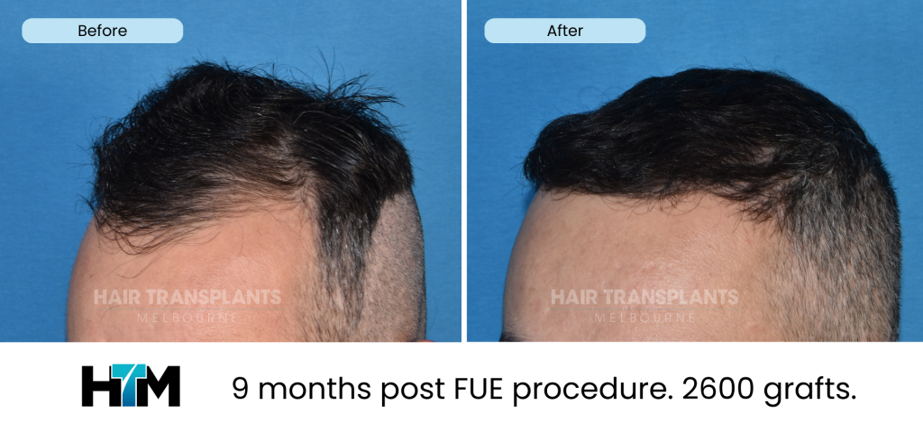 17.3 - 9 months post FUE procedure. 2600 grafts