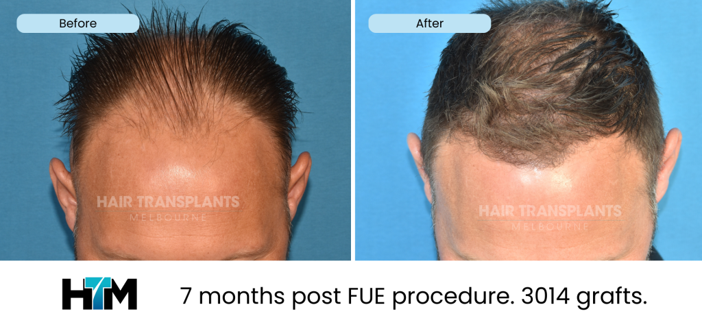 18.1 - 325418 - 7 months post FUE procedure. 3014 grafts