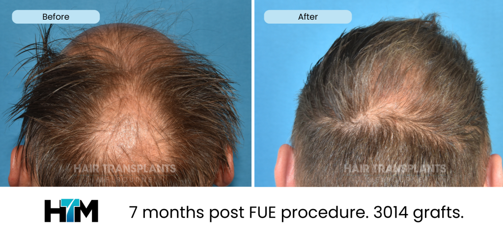 18.2 - 325418 - 7 months post FUE procedure. 3014 grafts